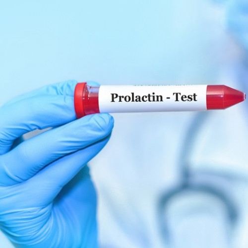 Testul de prolactină: importanța și momentul realizării acestuia